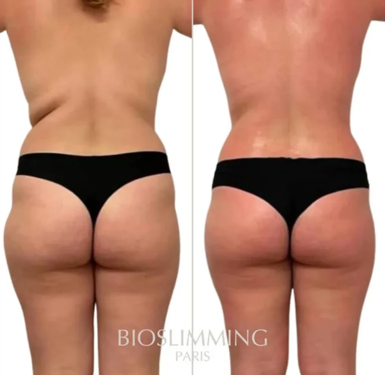 Voor-en-nafoto van BioSlimming Paris: rug, billen en bovenbenen in achteraanzicht