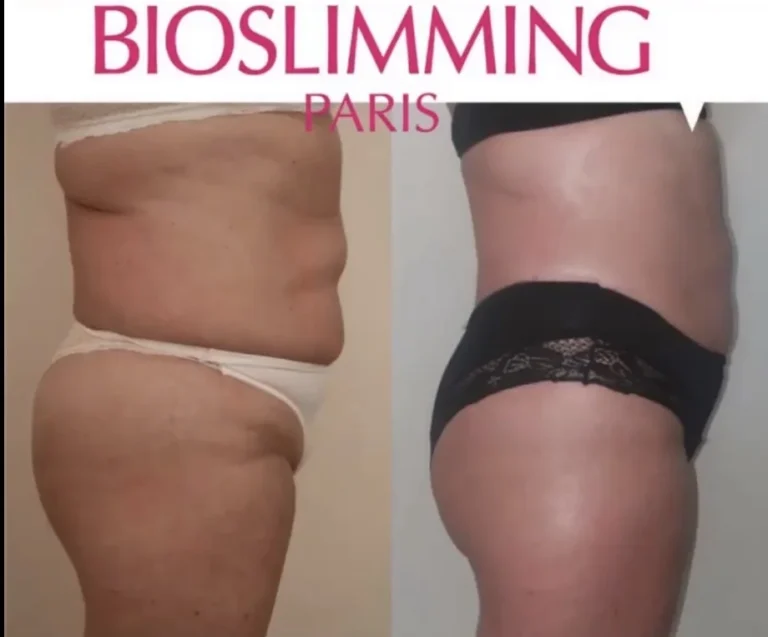 Voor- en nafoto van buik en heup na BioSlimming-behandelingen, beeld van BioSlimming Paris
