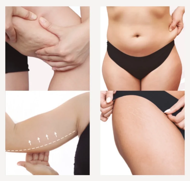 Collage van behandelingen met Bodyshock op buik, benen en armen